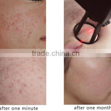 Eliminate Body Odor Medical Equipment Scar Removal CO2 Laser 480-1200nm 40w Skin Renew Fractional Spot Scar Pigment Removal Pigment Removal photo-6