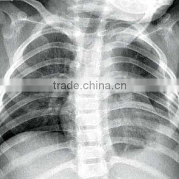 China KND-A/F CE medical dry film radiografia de torax puc