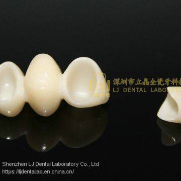 Dental Crown E.Max Ceramic, Porcelain Crown, Dental Veneers, Laboratoire Dentaire, Dentallabor, Laboratorio Dental, Dental Laboratory, Shenzhen LJ Dental Lab China photo-5
