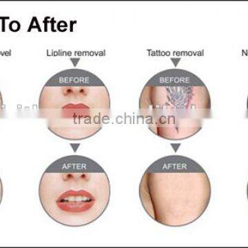 Screen Logo Customized Ipl Hair Removal, Shr Ipl Hair Removal, Ipl Hair Removal Machine Price photo-3
