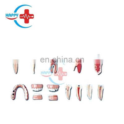 HC-S412 Medical  Dental lesion series model science dental diease model teeth lesions teaching model