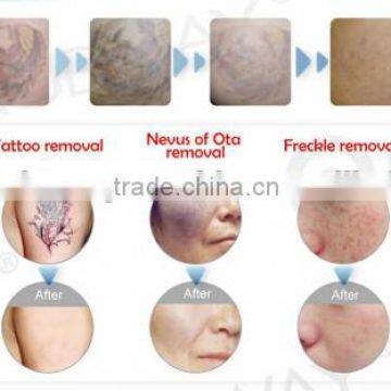 Q Switch Laser Tattoo Removal Powerful 1064nm Nd Yag Q 1500mj Switched Laser Tattoo Removal Machine Tattoo Removal Laser Equipment