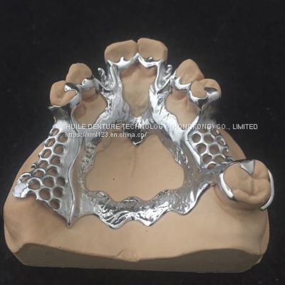 3D Laser Printing Precision Bracket Alloy Framework for Dentures