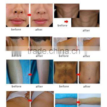 Permanent Factory Price 810nm Diode Laser For Hair Removal 810 Diode Laser Arm / Chest Hair Removal photo-6
