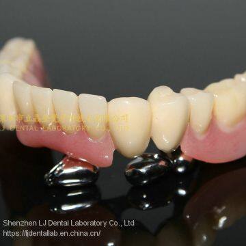 Dental telescope denture, telesope crown, dental prosthesis, laboratoire dentaire, Dentallabor, laboratorio dental, dental laboratory, Shenzhen LJ dental lab China