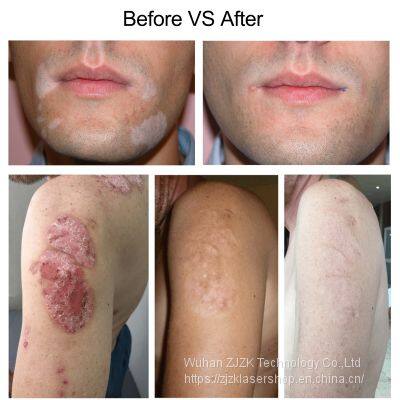 High Effective Solution 308nm Excimer Uvb Laser Vitiligo Treatment Device for Psoriasis and Vitiligo photo-5