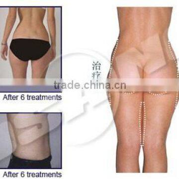 Cavitation And Radio Frequency For Weight Liposuction Costs in Egypt photo-3