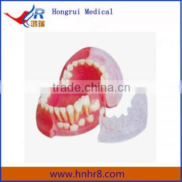 Hot Sale Three-year-old Primary and Permanent Teeth Alternating Anatomical Model