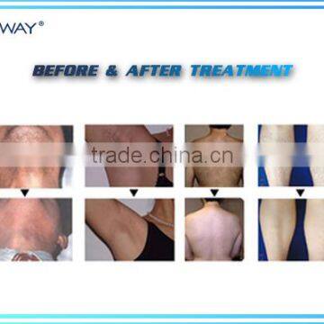 World Best Selling Products Beauty Machine Diode Laser for Hair Removal photo-5