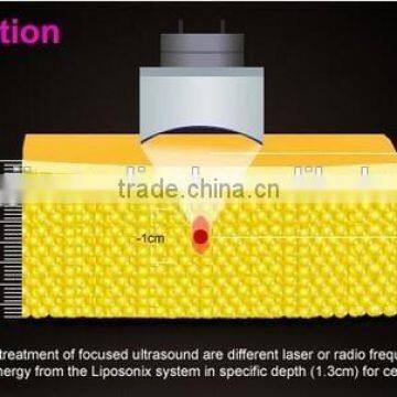 Liposonix Weight Loss Slimming Machine for Beauty Salon Use photo-5