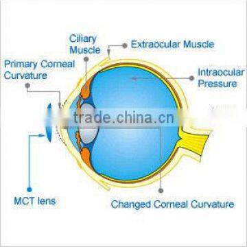 For low myopia/MCT lenses/MCT Technology hard contact lenses