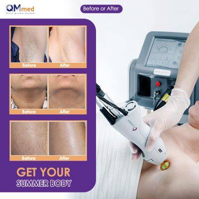 QM-755 Professional Candela 755nm Alexandrite Permanent Laser Hair Removal Machine