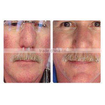 Beijing New Product 30W Diode Laser 980nm Vascular Vein Stopper Spider Vein / Laser Vascular Removal Machine / Laser for Face photo-6