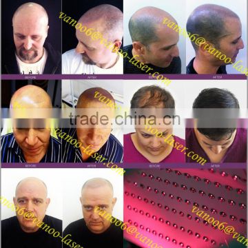 2015 LLLT low level laser hair regrowth equipment/anti-hair loss treatment