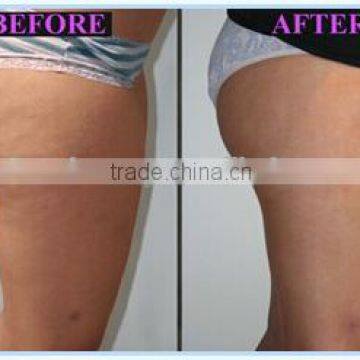 Cryo Lipolysis Fat Freezing Cryotherapy Cellulite Reduction Machine photo-4