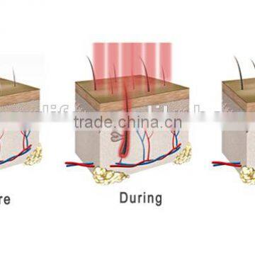 NL-SF650 Hot Sale Beauty Personal Hair Growth Laser Comb For Hair Regrowth Instant And Fast photo-5