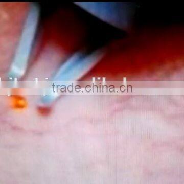 2015 New Technical Varicose Veins/blood Vessel Spider Vein Treatment/vascular Removal Machine photo-3