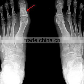 China KND-A/F CE medical dry film radiografia de pie izquierdo