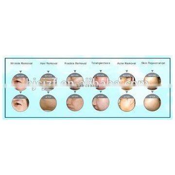 Vascular Lesions Removal SK-11multifunction Machine E Light/IPL/RF Ipl E-light Remove Tiny Wrinkle E Light Ipl Rf System Shrink Trichopore