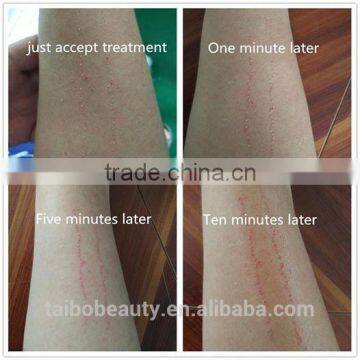 Best Selling Skin Rejuvenation 1064nm 532nm q Switch nd Yag Laser Tattoos Removal Clinic Medical Machine uk Distributor Wanted