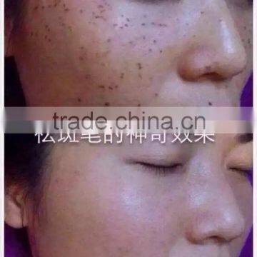 Spot Removal Pen Tattoo Removal Pen For Home Use photo-5