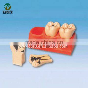 BIX-L1005 Dental caries decomposition model