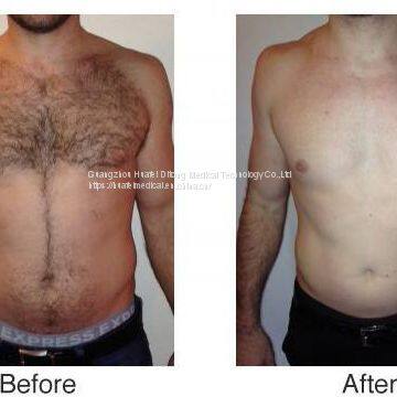 500W Best Diode Laser Hair Removal Beauty Machine photo-5