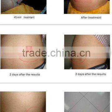 HOT SELLING !!Fat Frozen Equipment Cryolipolysis Slimming Equipment photo-6
