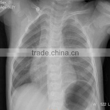 China fuji drypix xray film use in hospital