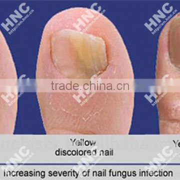 ringworm of the nails laser therapy device