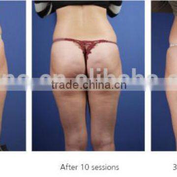 2016 Best Fast Pain Relief Cellulite Removal Shock Wave Acoustic Wave Machine photo-6