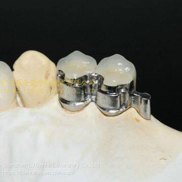 Dental Precision Attachment, Dental Attachment, Dental Denture, Laboratoire Dentaire, Dentallabor, Laboratorio Dental, Dental Laboratory, Shenzhen LJ Dental Lab China photo-2