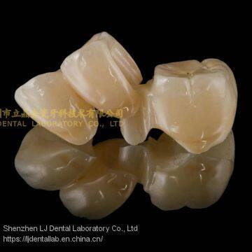 Dental Crown Zirconia Cercon,dental Teeth,dental Prosthesis Laboratoire Dentaire, Dentallabor, Laboratorio Dental, Dental Laboratory, Shenzhen LJ Dental Lab photo-4