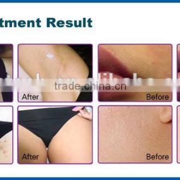 2016 Distributors Wanted Perfect Diode Laser 808nm Hair Removal Device With CE,ROHS photo-4