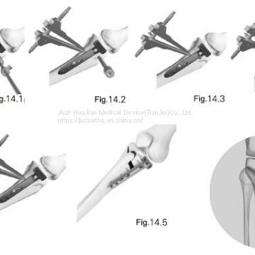 Periarticular Locking Plate System  Material: Ti