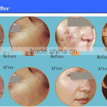 Fractional Co2 Laser Vaginal Equipment/Skin Renewing Sun Damage Recovery Rf Tube Supercritical Co2 Extraction Machine Skin Resurfacing photo-6