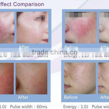 China Top Ten Selling Products Vascular Vein Removal / Varicose Veins Laser Treatment Machine photo-3