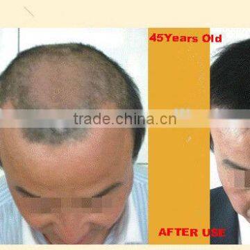 L81 sunburst hair growth Sunburst Herbal ingredient 4 bottles in 1 set Promote hair growth sunburstInhibition of hair loss