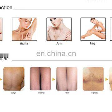 New Year Promotion Niansheng Factory Commercial 808nm 810 Diode Laser Hair Removal Machine Price photo-5