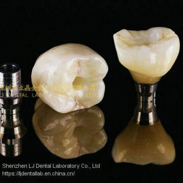 Dental implant crown, integrated abutment crown IAC, implant prosthesis, laboratoire dentaire, Dentallabor, laboratorio dental, dental laboratory, Shenzhen LJ dental lab China