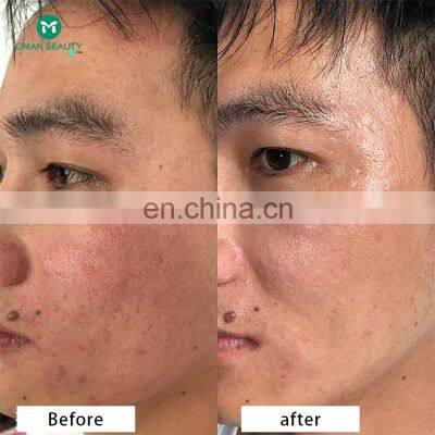 Portable Mini rf Fractional Laser Microneedle Machine 2021 photo-5