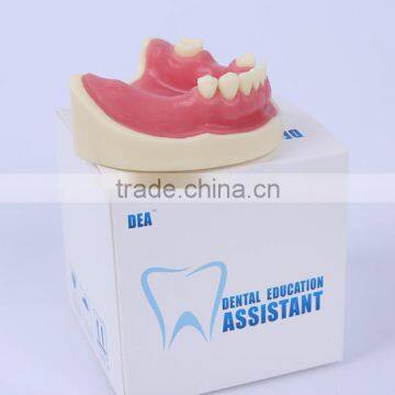 wholesale Dental Teaching implant model Medical teeth implant model with lower price