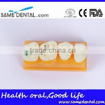 Pit and Fissure Model Dental Eduction Assitant No. DEA-19