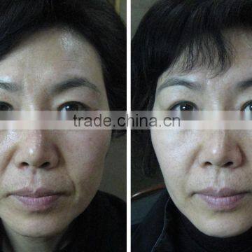 Ultrasonic Operation System and Anti-wrinkle Machine Type HIFU Machine Face Lift photo-3