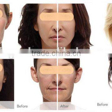 Vagina Tightening 2015 Advanced Vaginal Tightening Fractional Co2 Laser Bison Fractional Rf Beauty Machine Tattoo /lip Line Removal photo-2