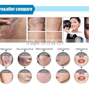 Hot Selling Import Laser Bar Portable Q-switched Nd:yag Laser Tattoo Removal Device photo-6