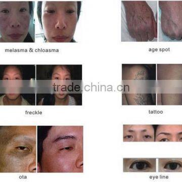 Freckle Removal Tattoo Removal Hair Removal 1064 nm 532nm nd Yag Laser photo-6