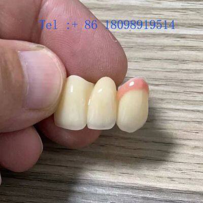 Expander Orthodontic in China Dental Lab