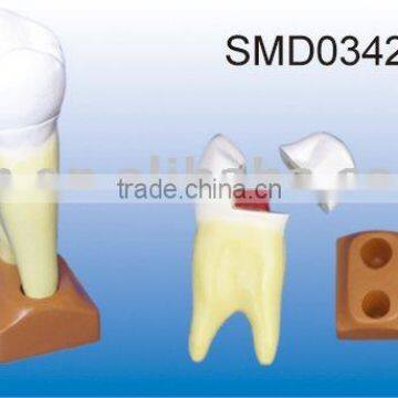 maxillary tow roots caries