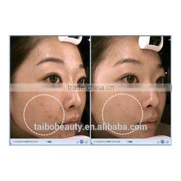 Professional Diamond Water Dermabrasion Face Cleaning Machines photo-6